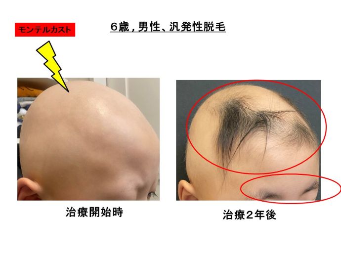 円形脱毛症　病院